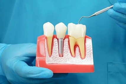 5 Common Myths About Dental Implants Debunked